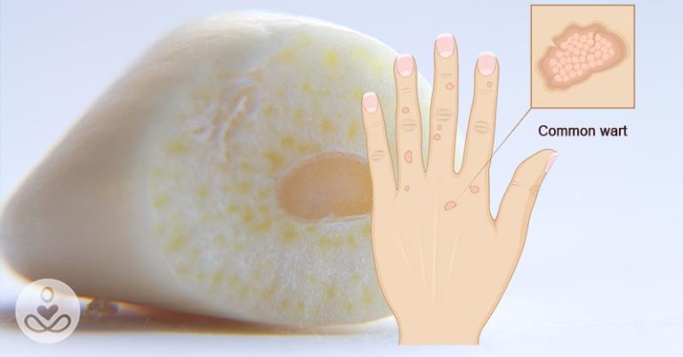 How to remove moles, warts, blackheads, skin tags, and age spots completely naturally - Featured image