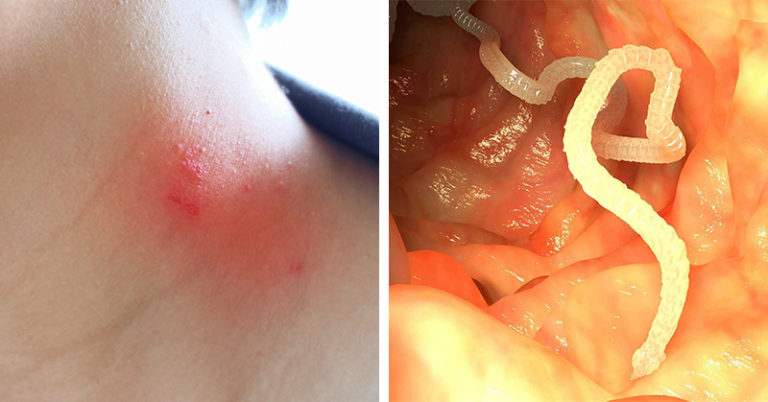 21 Signs Parasites are Living In Your Body – Use These Herbs to Help Kill Them - Featured image