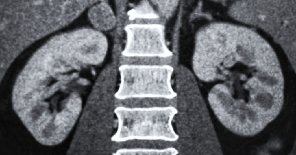 The Potential Revolution: An Artificial Kidney that Could Transform Kidney Care - Featured image