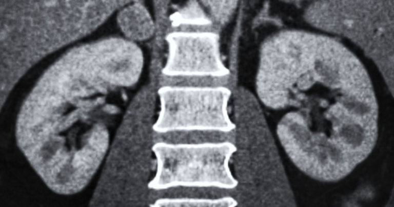 The Potential Revolution: An Artificial Kidney that Could Transform Kidney Care - Featured image