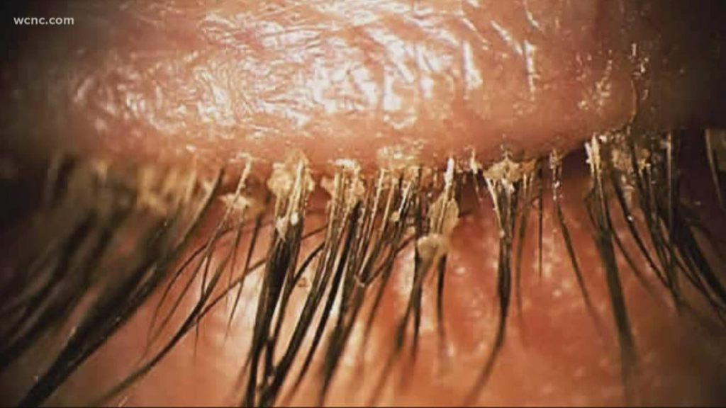 Eyelash extensions can bring mites, health officials warn - Featured image