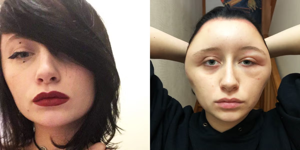 Woman’s Head Nearly Doubles In Size After Allergic Reaction To Hair Dye - Featured image