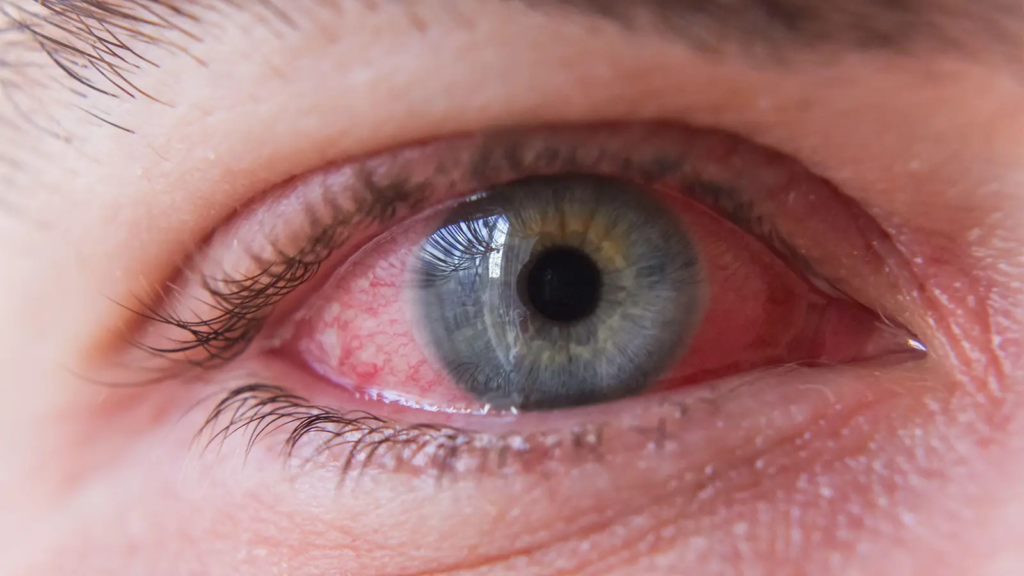 What Causes Conjunctivitis? A Panoply of Pathogens, Study Shows - Featured image