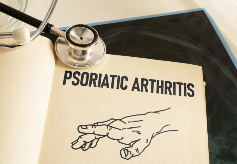 The Effects of Psoriatic Arthritis on Tendons and Ligaments - Featured image